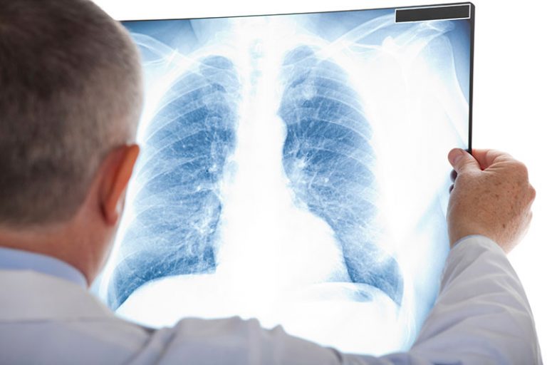 Lung Cancer Screening Program Launched To Bridge Access To Care In ...