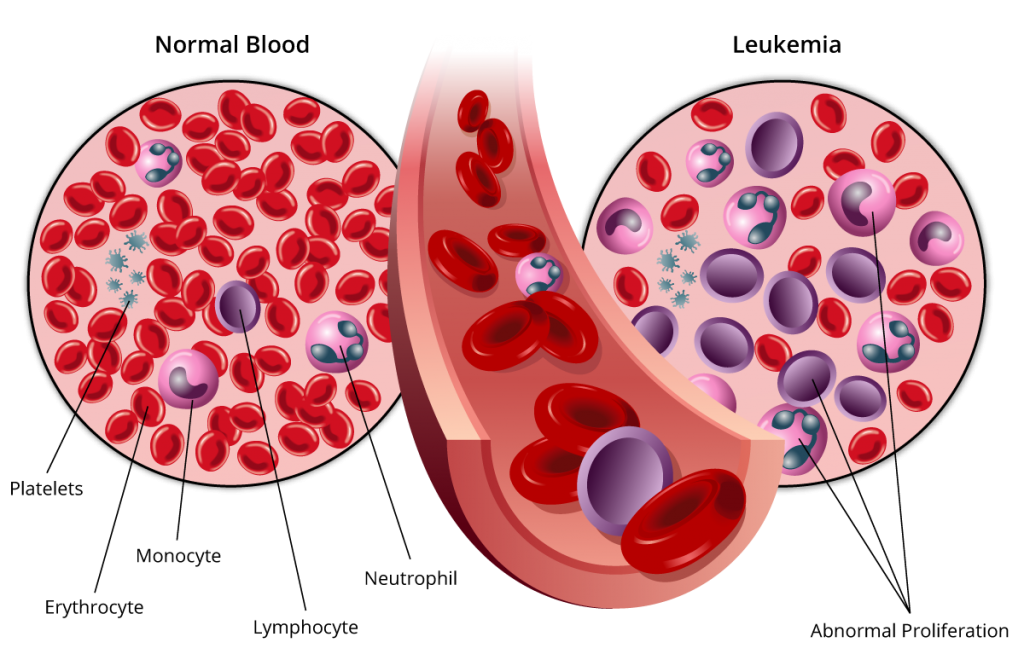 stages of blood cancer
