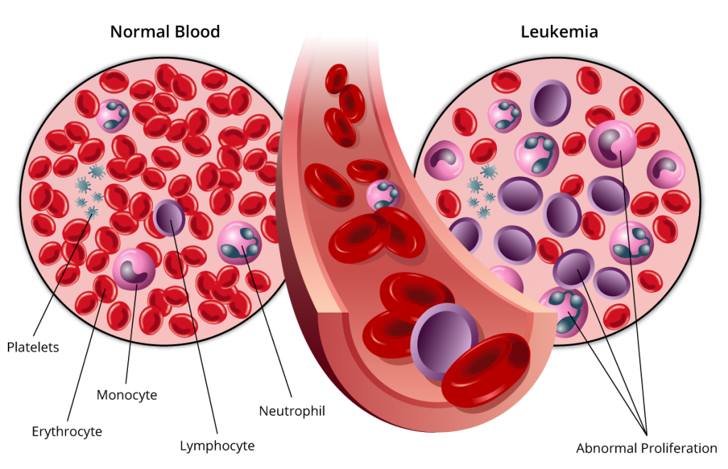 Leukemia - West Cancer Center