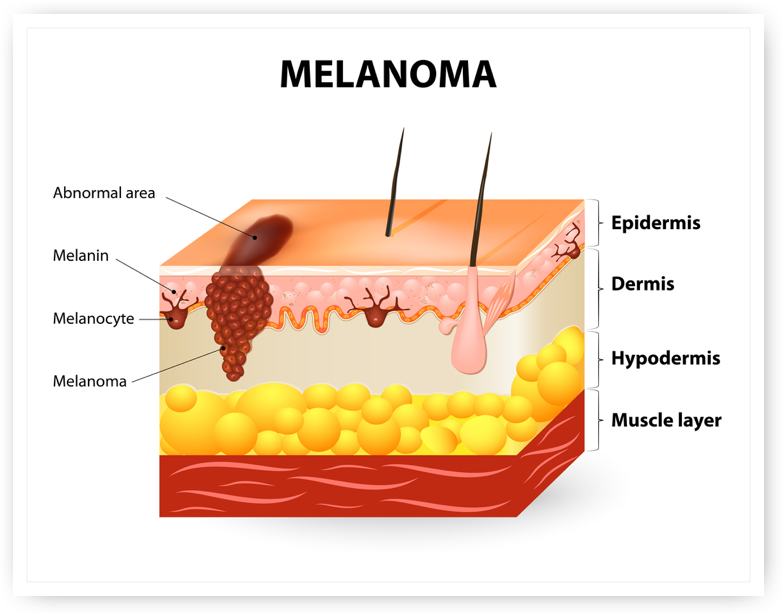 Melanoma Skin Cancer Diagram 1913