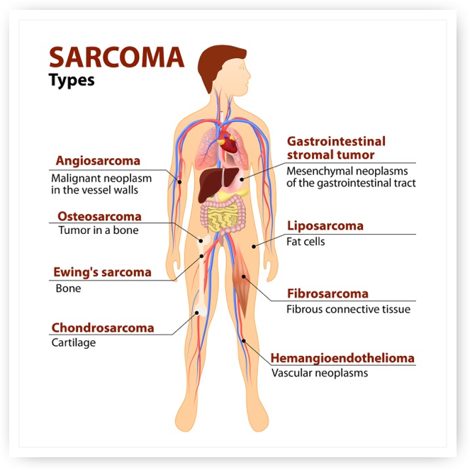 Sarcoma cancer forehead. Sarcoma cancer treatments, Traducere 
