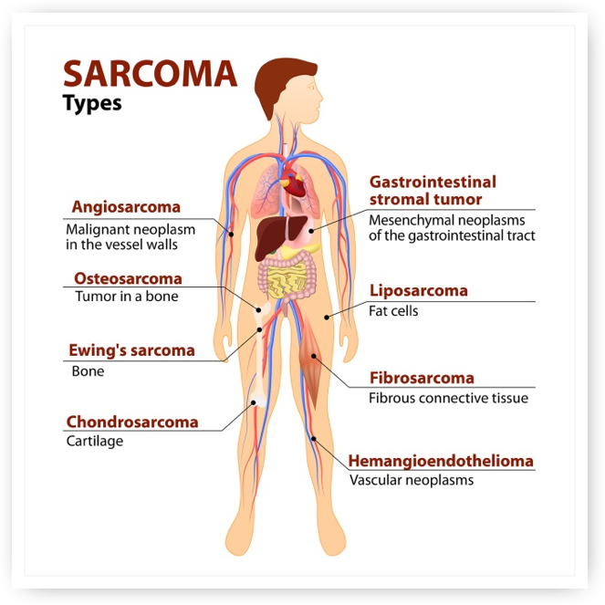 Synovial Sarcoma: What Is It, Diagnosis, Treatment & Prognosis