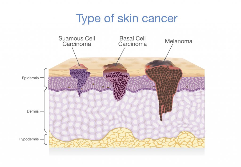 Melanoma West Cancer Center